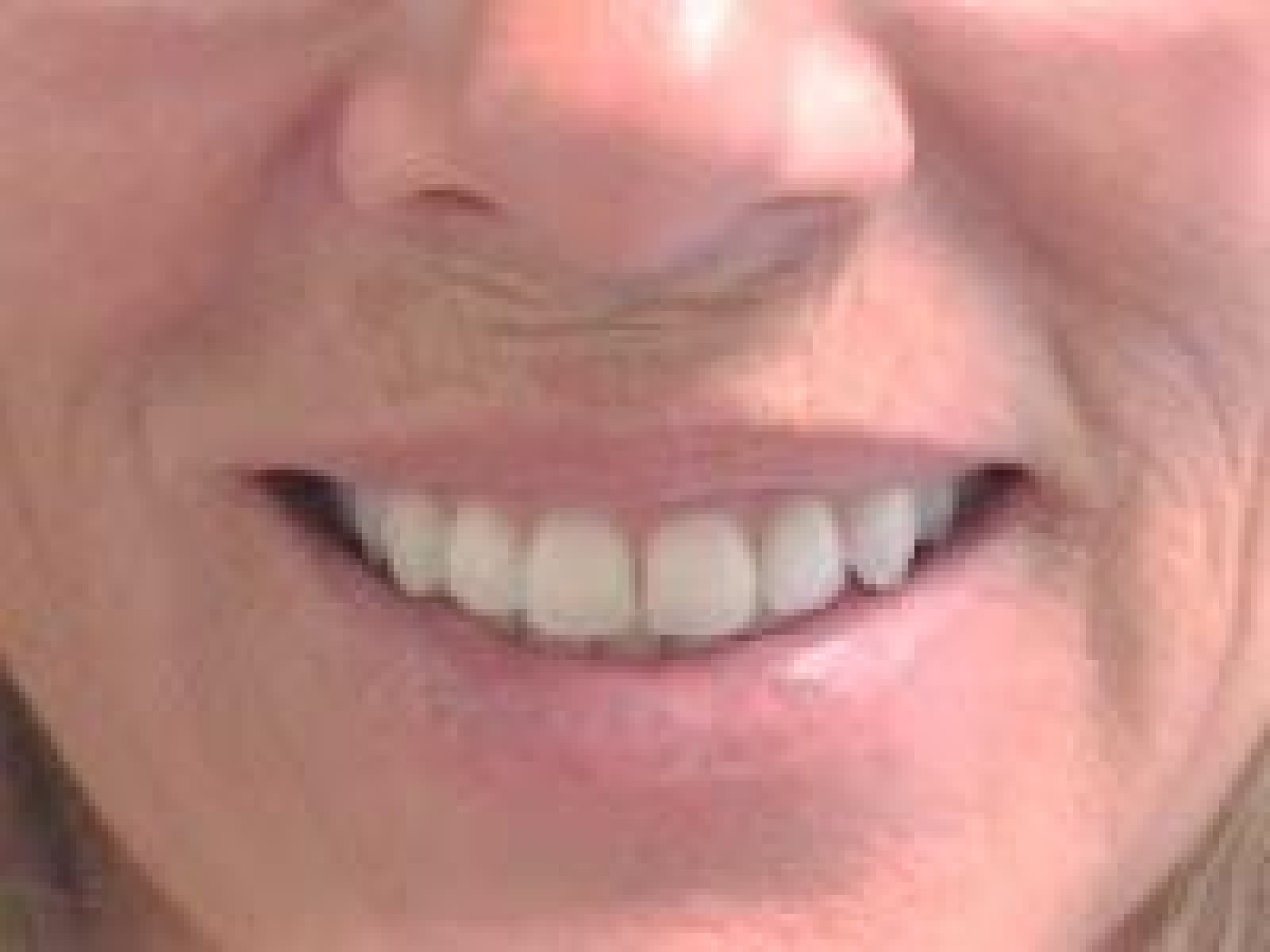 Smile design classic denture studio dental implants dental prosthesis